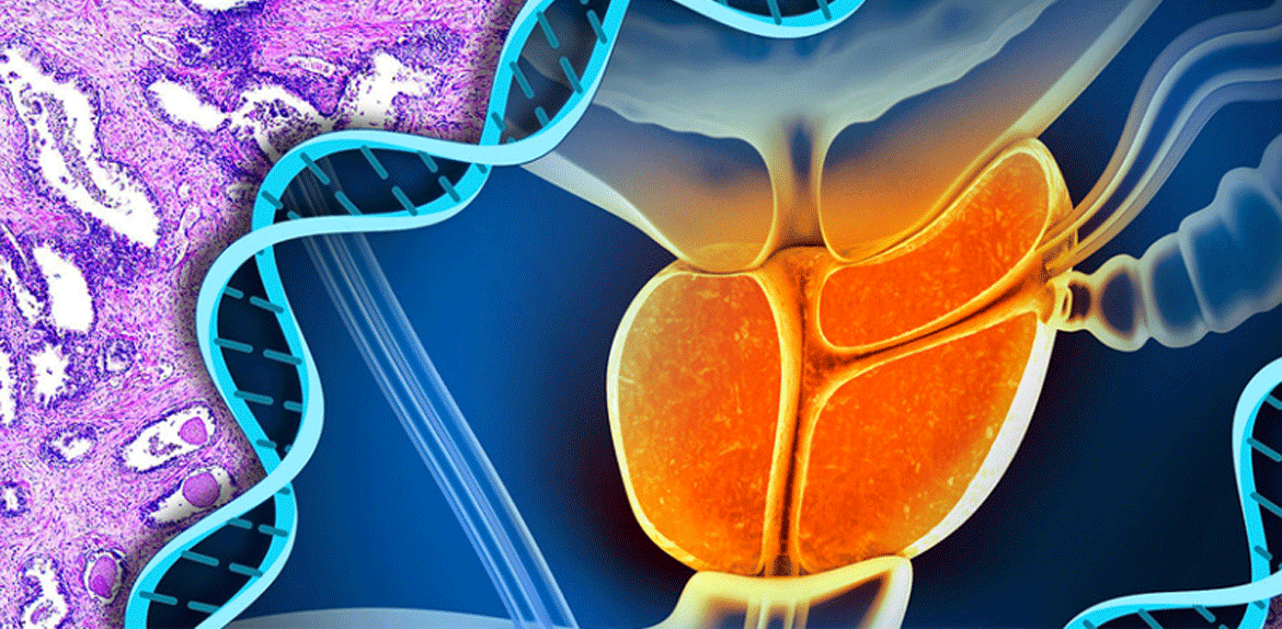 Novas tecnologias contribuem para o rastreamento e diagnóstico do câncer de próstata